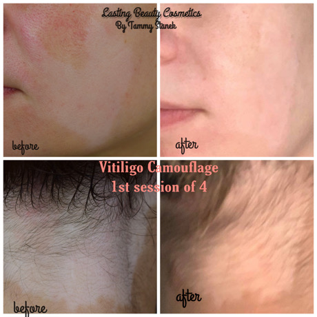 Vitiligo Camouflage by Lasting Beauty Cosmetics, Tammy Stanek